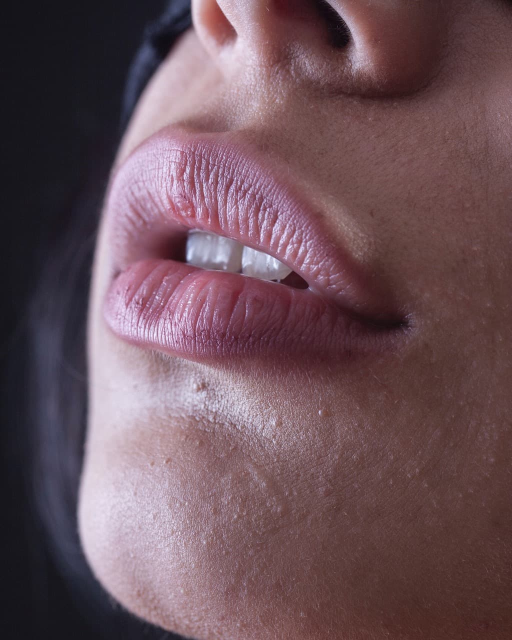 Why Lip Filler Migrates And How To Handle It
