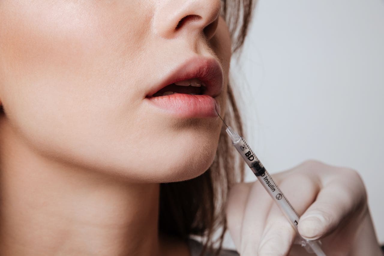 10 Things To Know Before Getting Lip Filler For The First Time