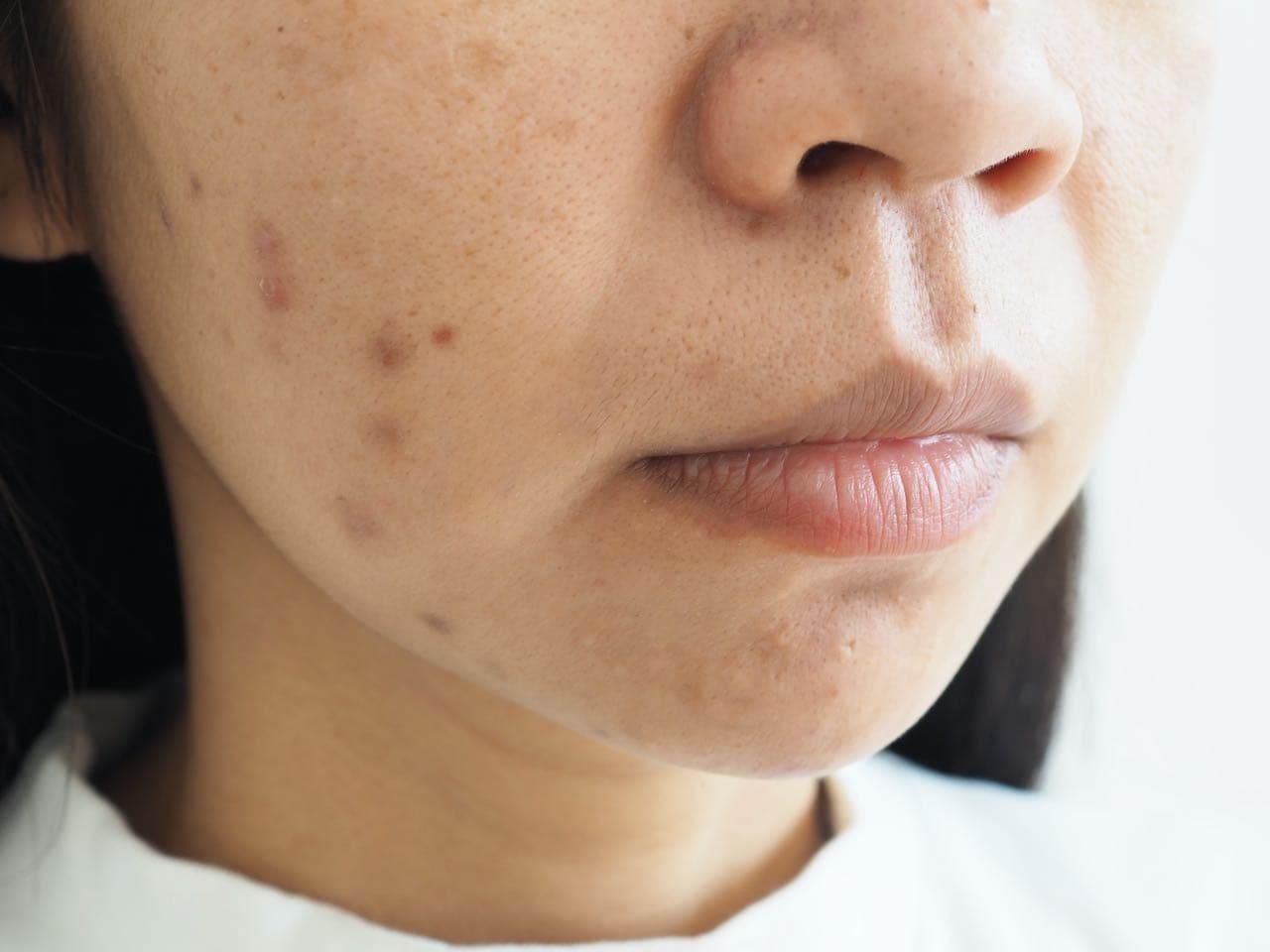 How To Treat Post-Inflammatory Hyperpigmentation Caused By Acne