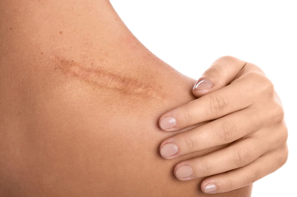 Dermabrasion Might Be the Scar Treatment You've Been Looking For