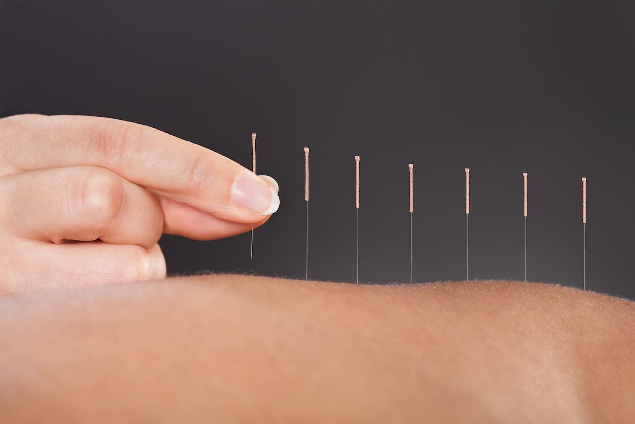 5 Benefits Of Acupuncture You May Not Know About