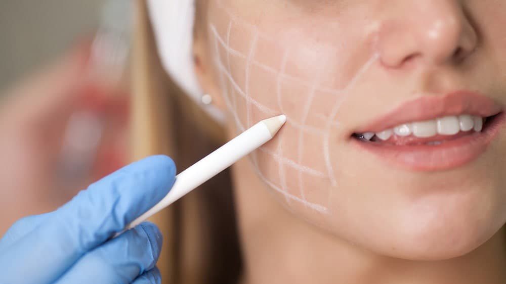The Skinny On Buccal Fat Removal