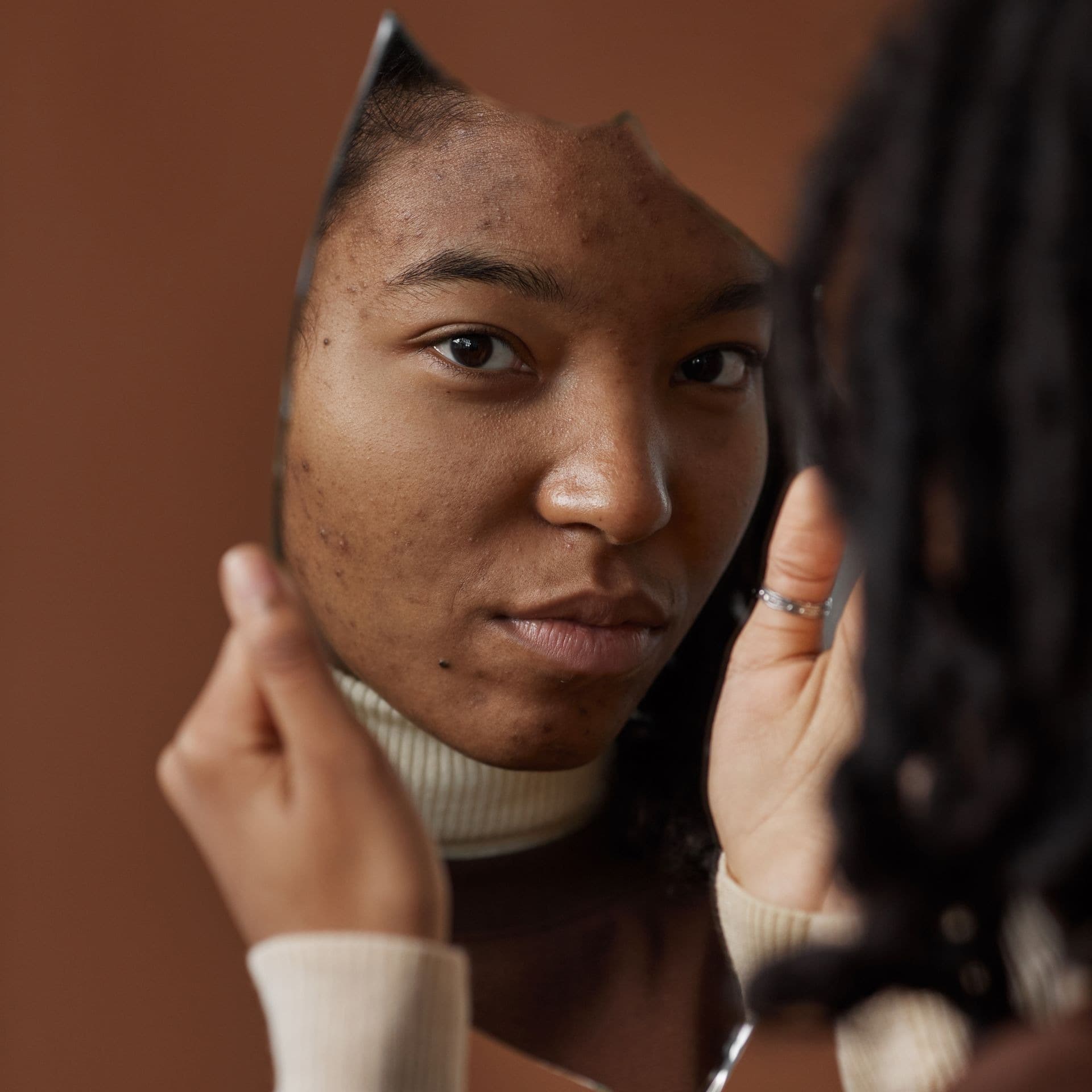 The AEDIT team covers Acne Scar Treatment: Why One Treatment Is Rarely Enough.