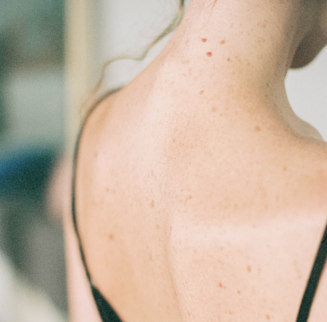 Everything You Need To Know About Pigmentation On The Body