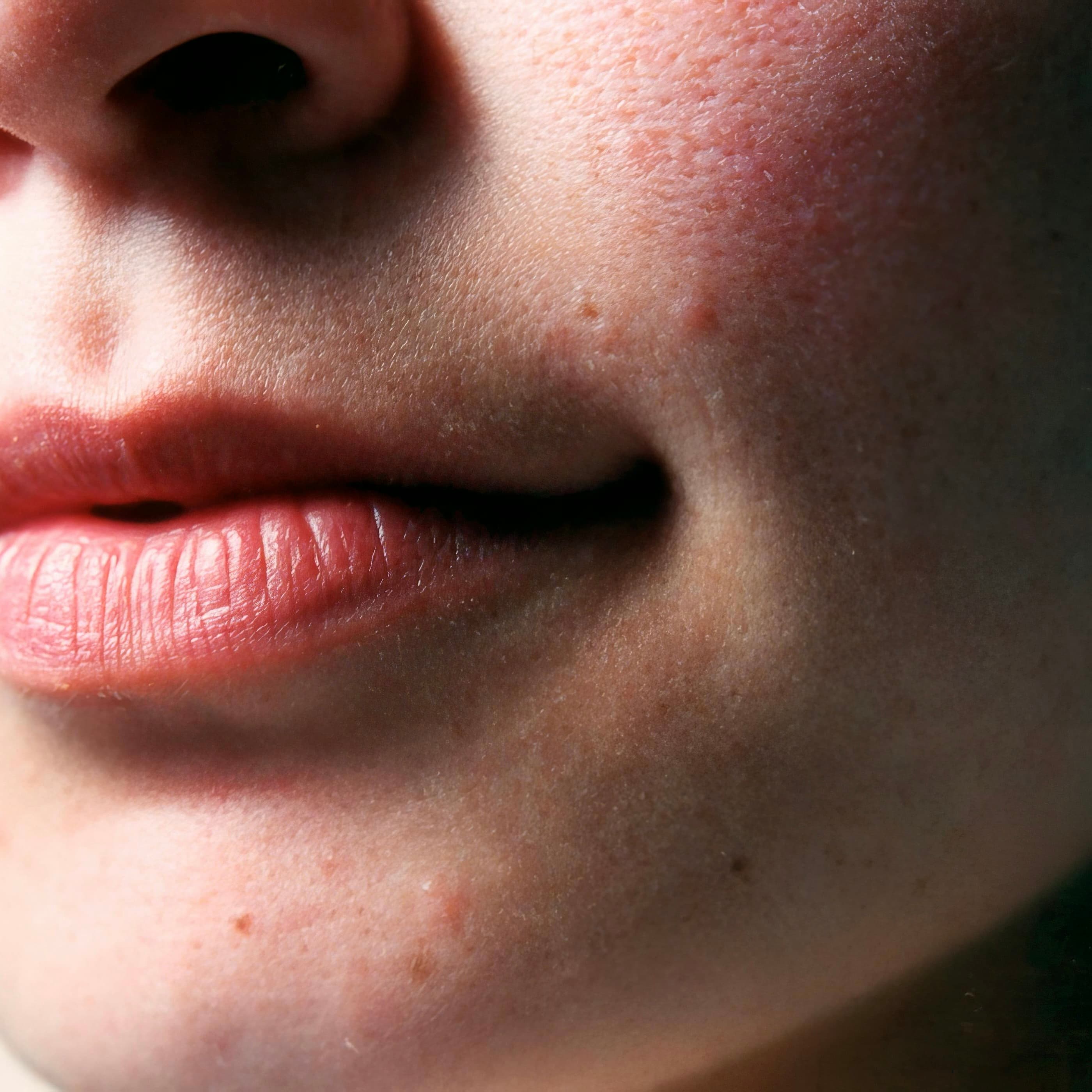 A detailed close-up of a person’s lower face showing early signs of rosacea, visible redness, small bumps, and uneven skin texture on the cheeks and chin, commonly associated with rosacea flare-ups.