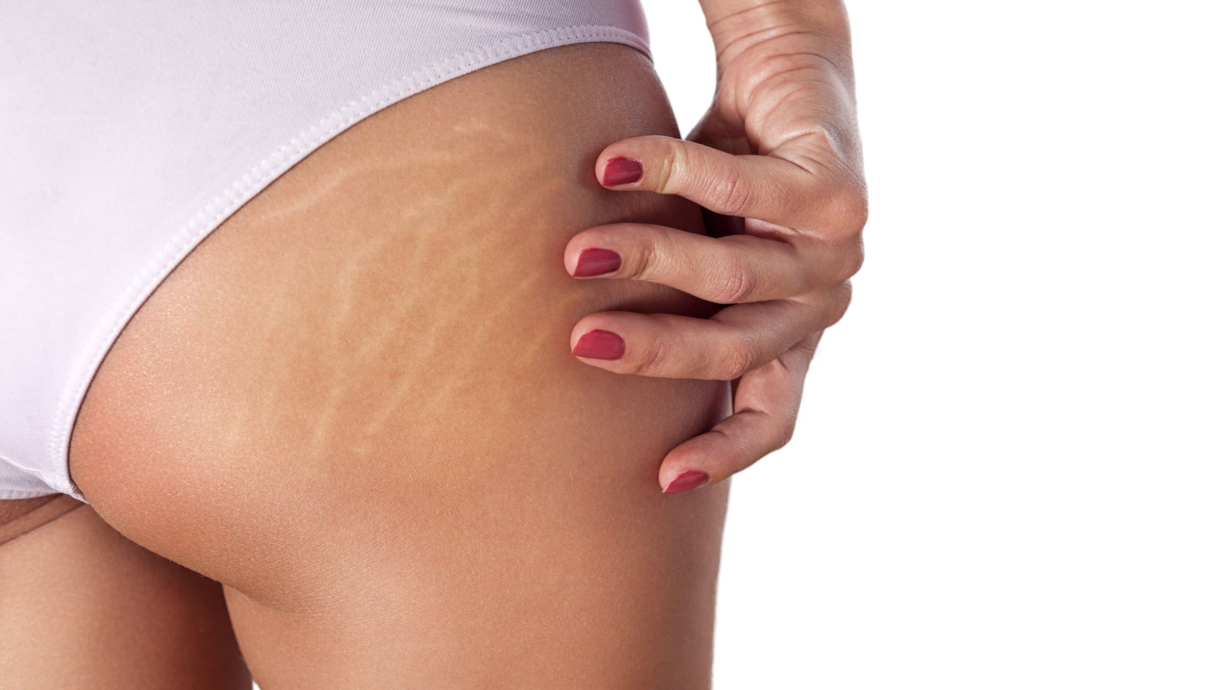 How To Treat Stretch Marks