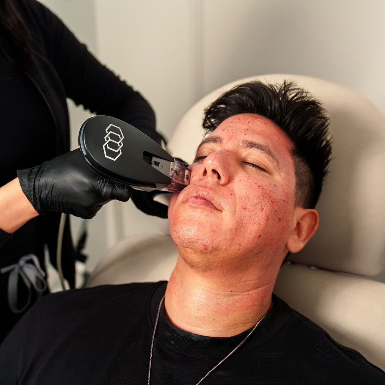 The AEDIT team covers The Return of Aggressive Aesthetic Treatments.