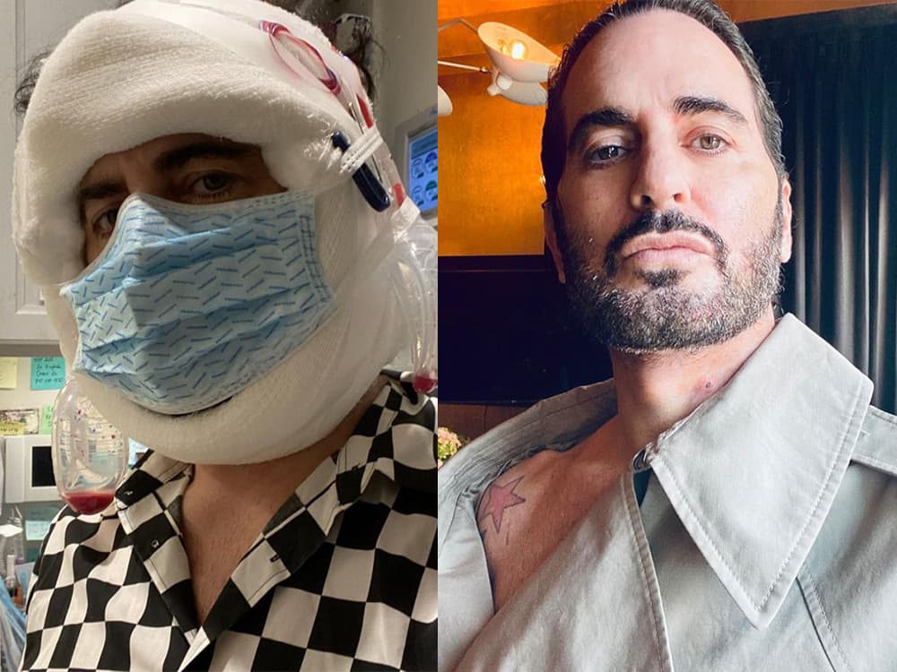Why Marc Jacobs’ Transparency About His Facelift Matters