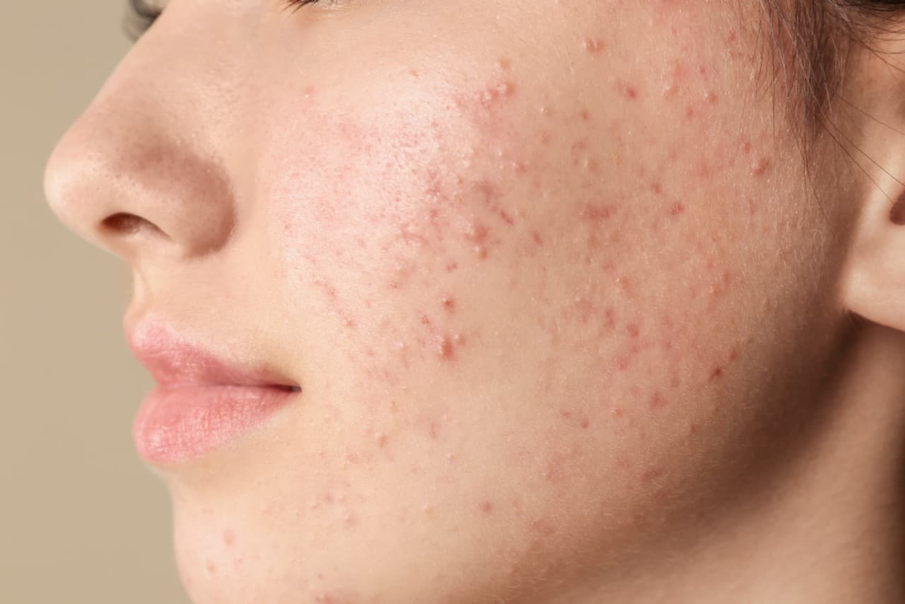 8 Dermatologists Share Their Favorite In-Office And At-Home Acne Treatments