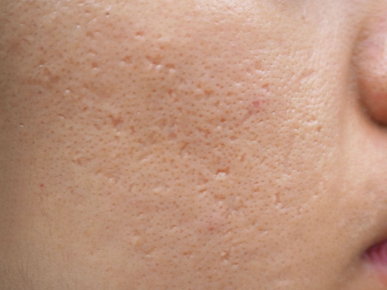Scar Wars: How To Treat Every Type Of Scar