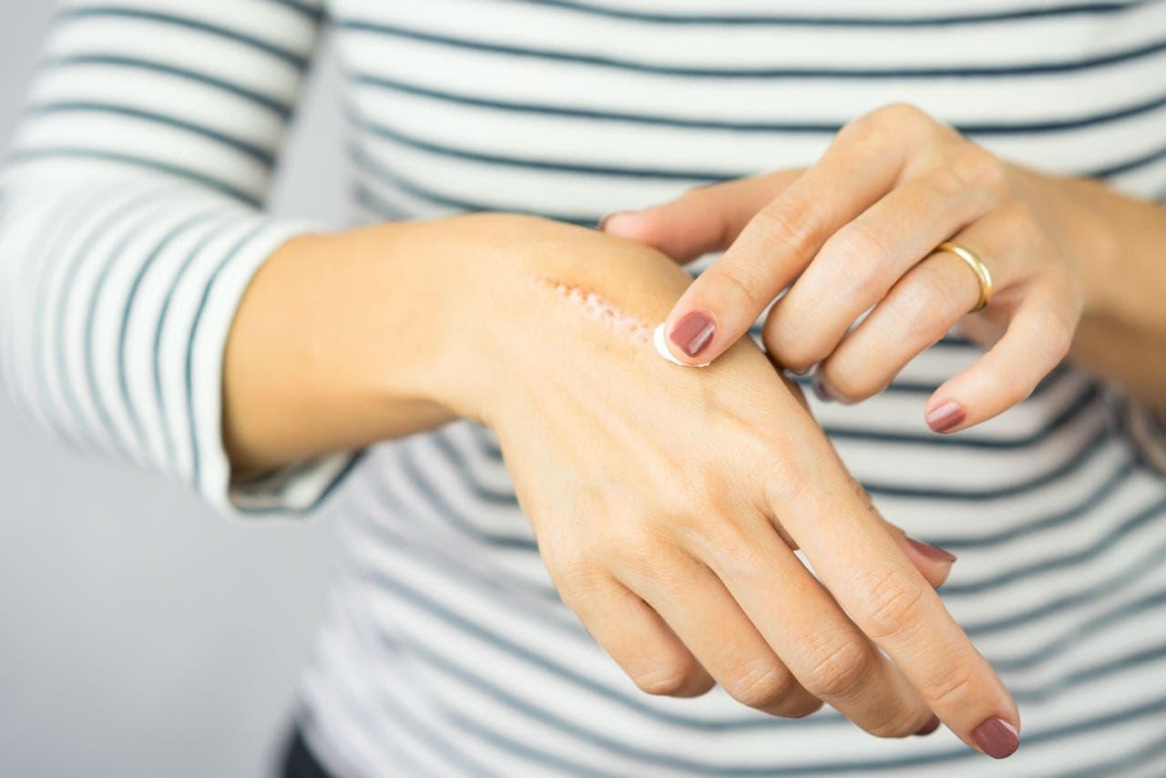 Everything You Need To Know About Treating Burns